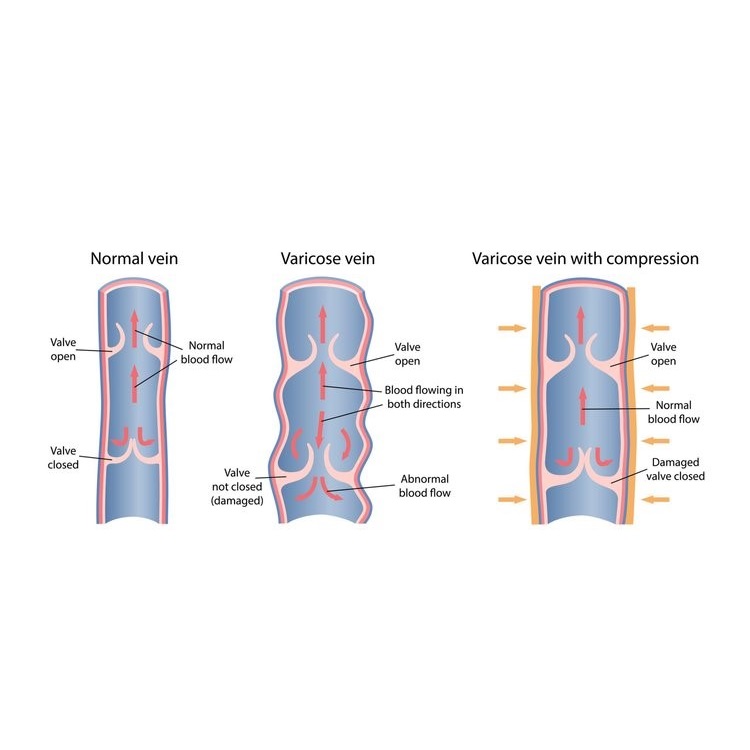 Varicose Veins