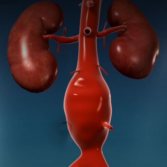 abdominal Aortic Aneurysms