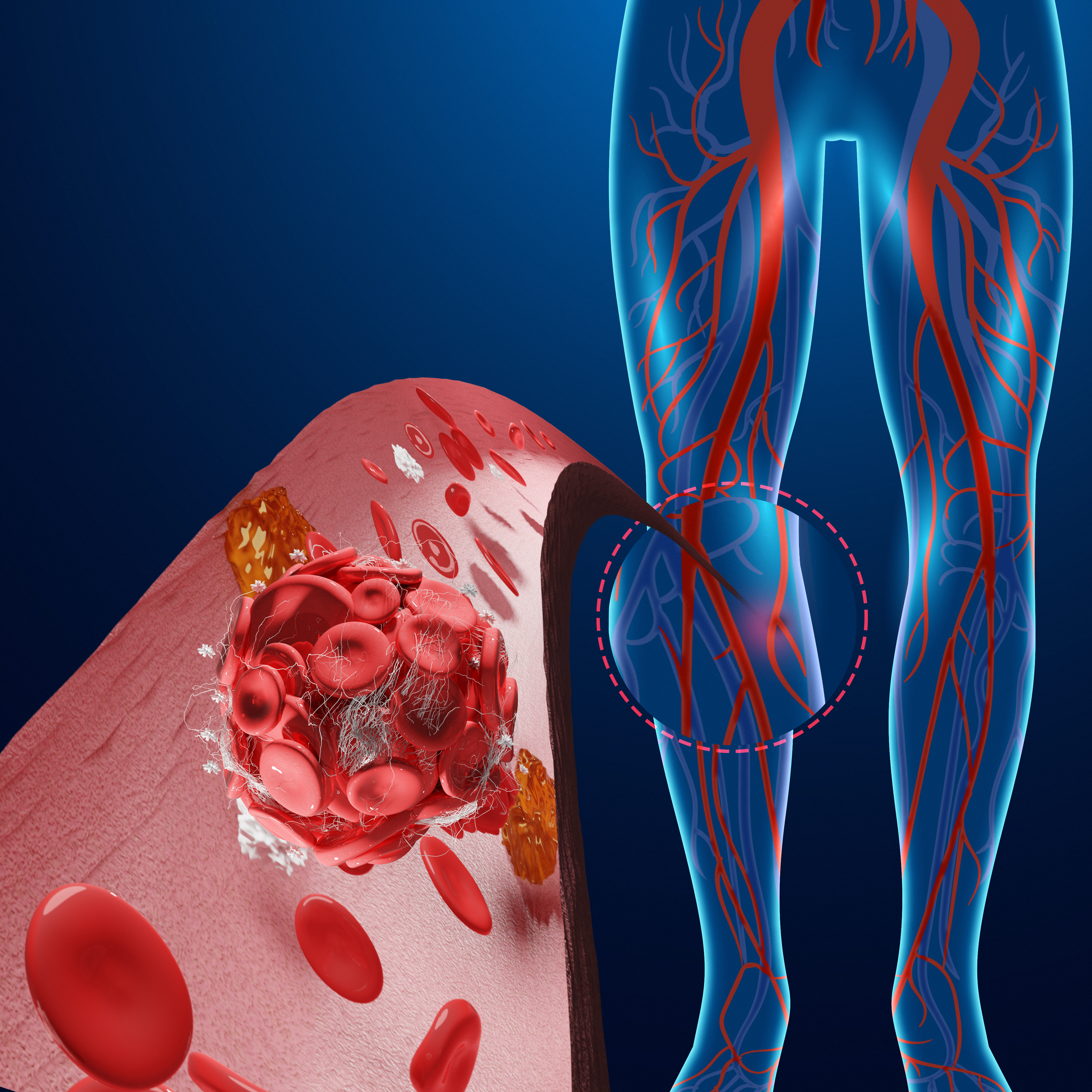 Types of Vascular Disease